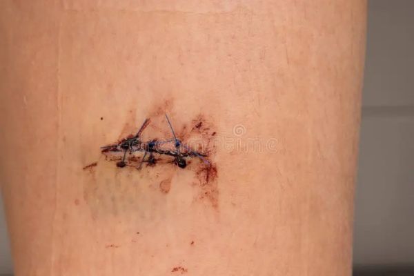 right thigh open external wound