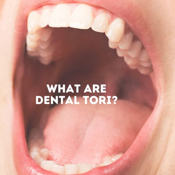 tori on gums