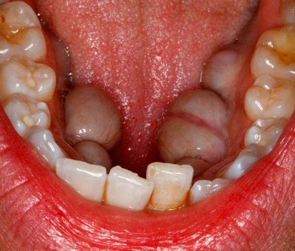 mandibular torus or exostosis