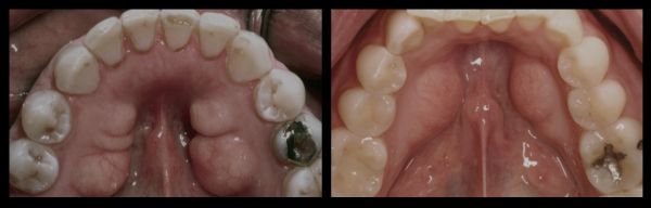 tori mouth bone growth