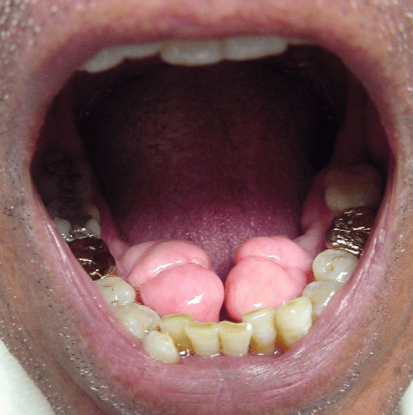 tori teeth problem