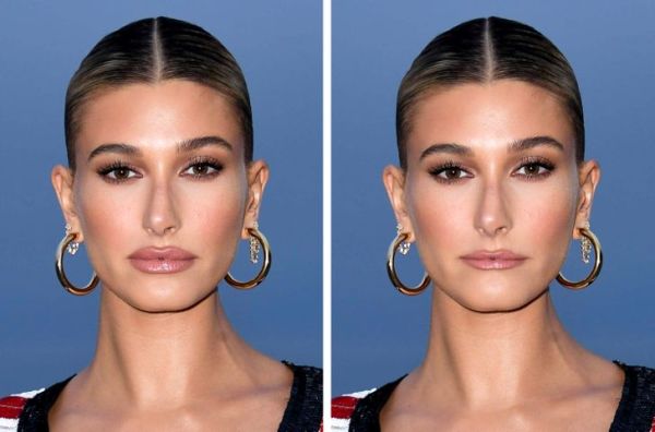botox lip injections