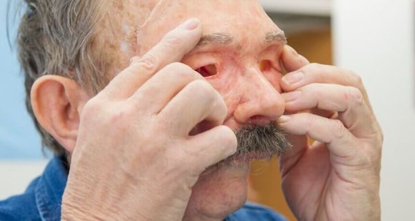 prosthetic beauty
