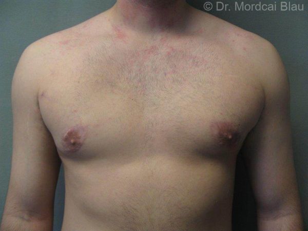 gynecomastia types and stages