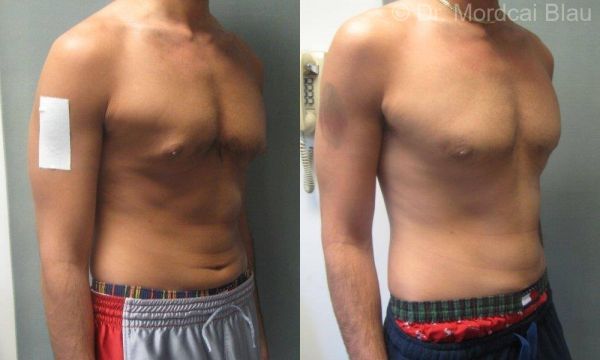 ape gynecomastia