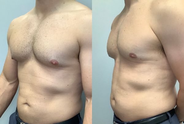 gynecomastia affects