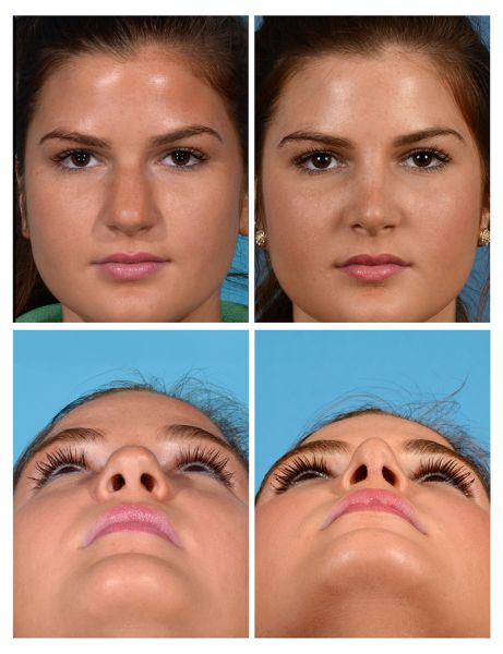 bulbous tip rhinoplasty