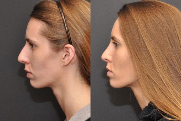 rhinoplasty side profile