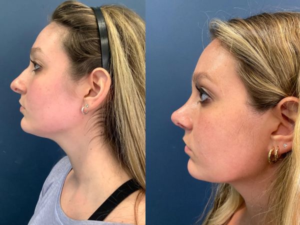 plastic surgery rhinoplasty