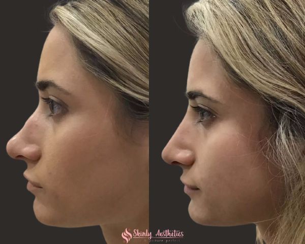 crooked nose before and after