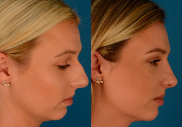 african american nose job