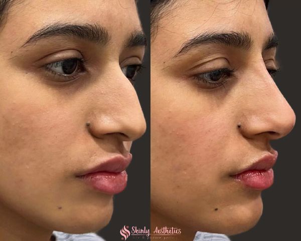bad rhinoplasty