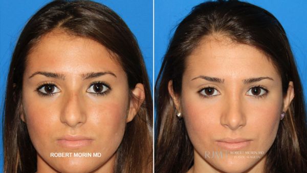 bulbous nose job before and after