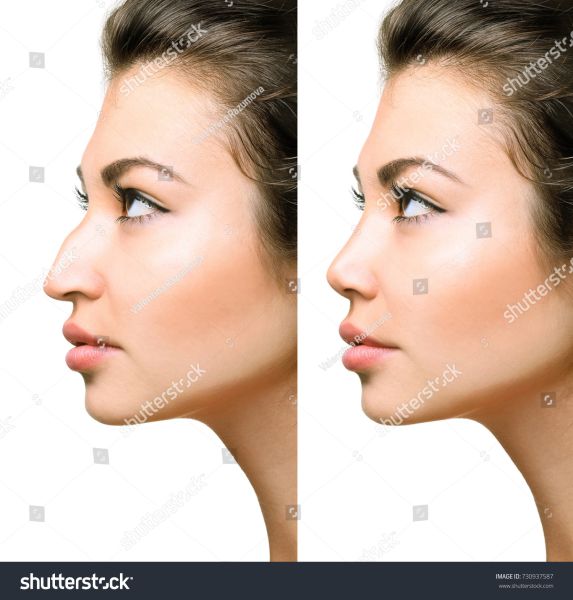 swelling after rhinoplasty