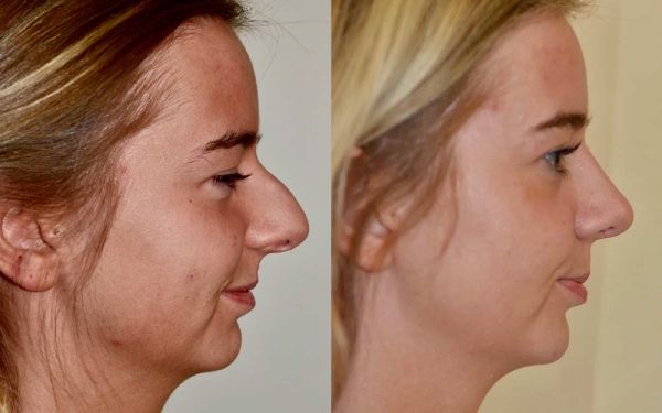 what is rhinoplasty