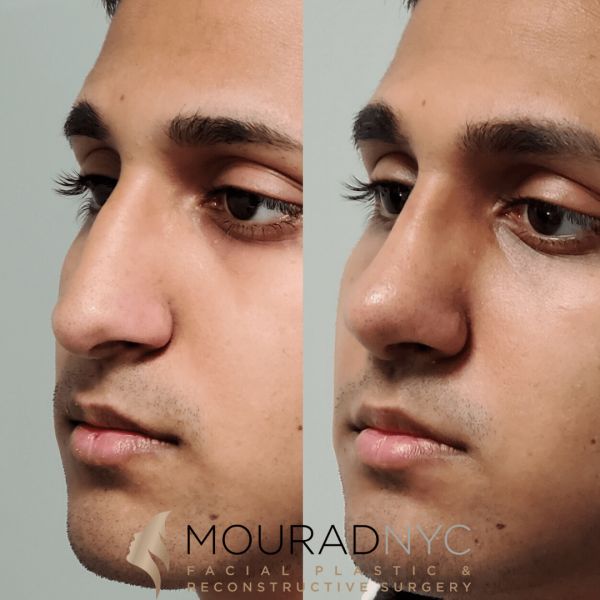 rhinoplasty