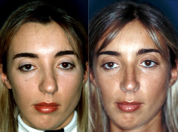 deviated septum surgery with rhinoplasty male