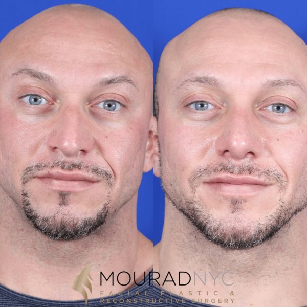 what is deviated septum