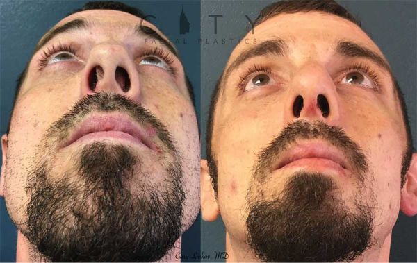 diseased sinus