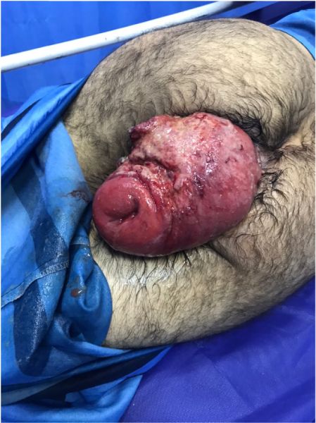 clariet anal prolapse