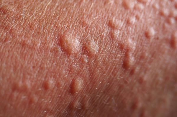 bumpy spots in skin