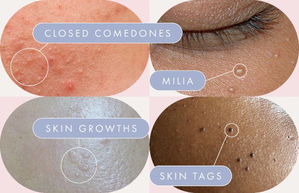 skin swelling bumps