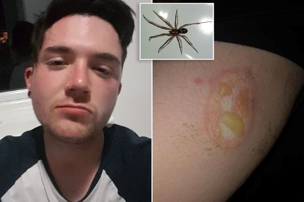 flea bug bites on humans