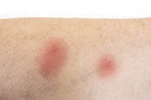 bug bites that blister