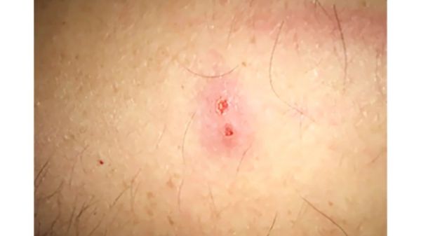 mrsa infection spider bite