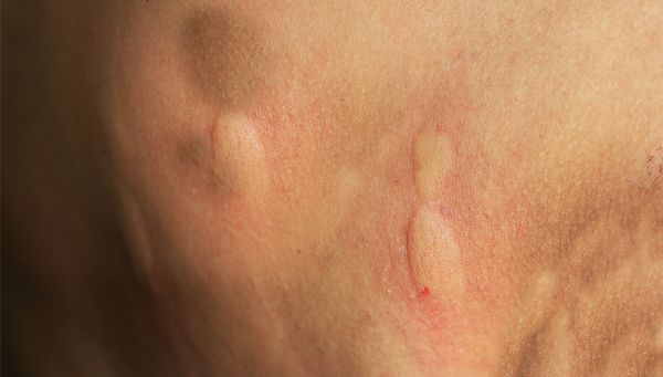 brown recluse spider symptoms