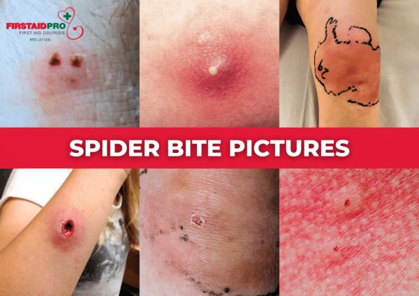 insect bites identification