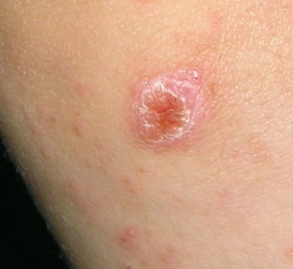 tick bug bite