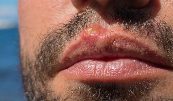 burnt lips from smoking