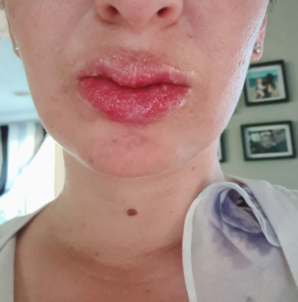 sun burn lip pictures
