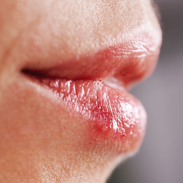 fever blisters on lips
