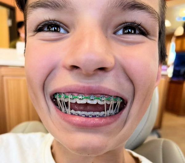 cool braces colors