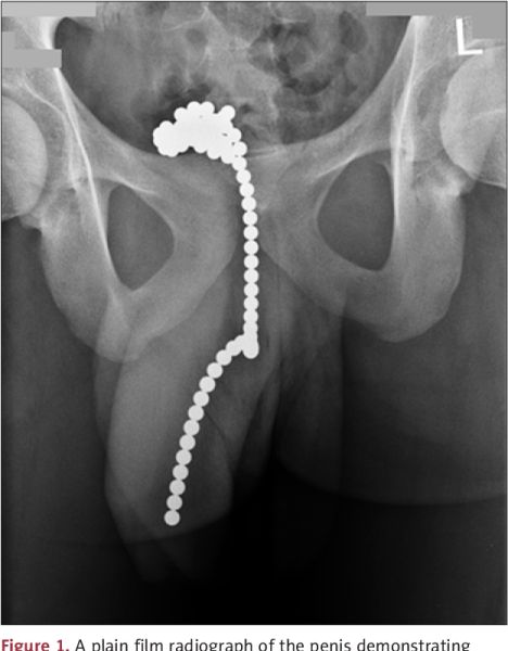 urethral stricture x ray