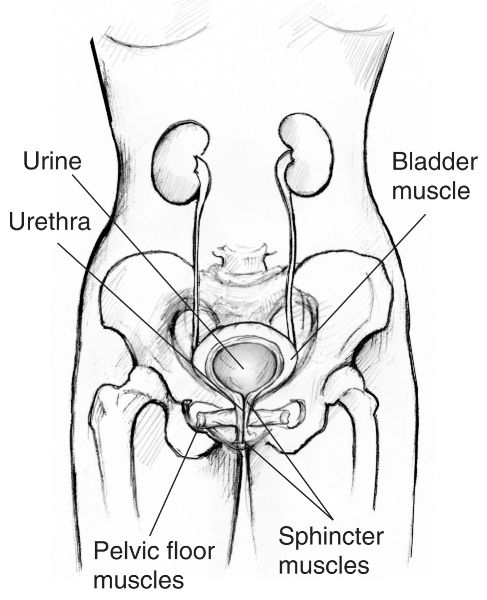 urinary incontinence plugs