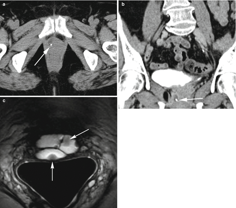 mid urethral sling anatomy