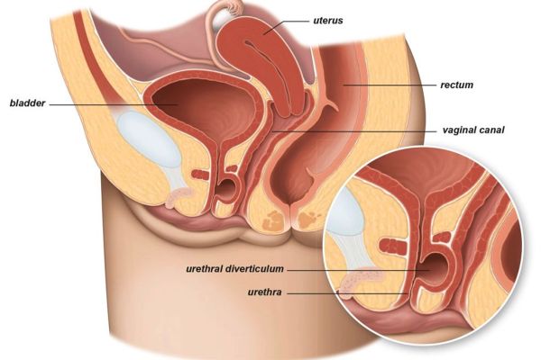 urethral catheter largest size