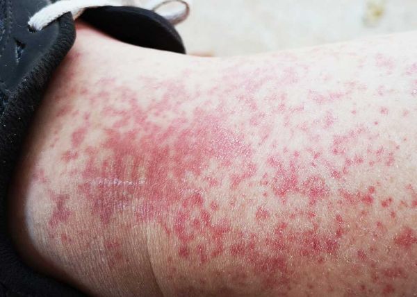 lichen planus keratosis