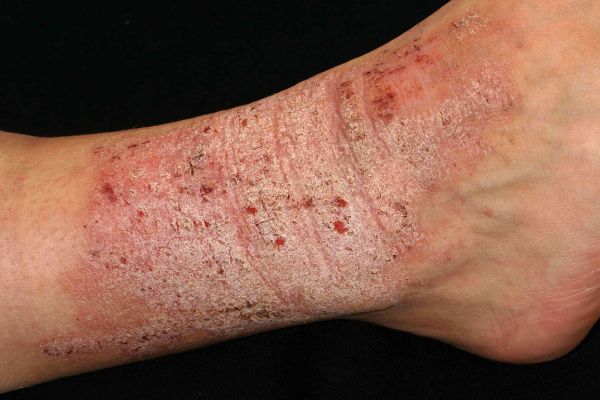 advanced lichen sclerosus