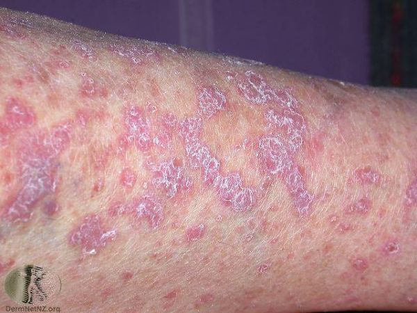 vulvar lichen planus dermatology