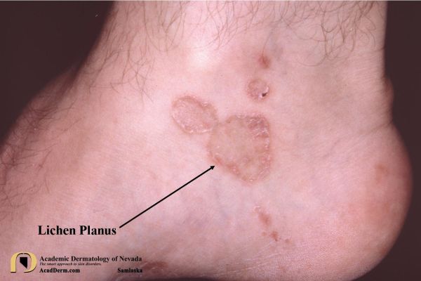 mild lichen sclerosus