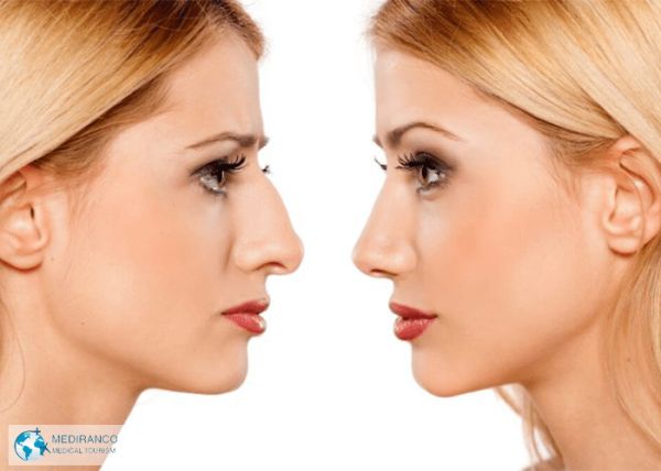 post deviated septum surgery