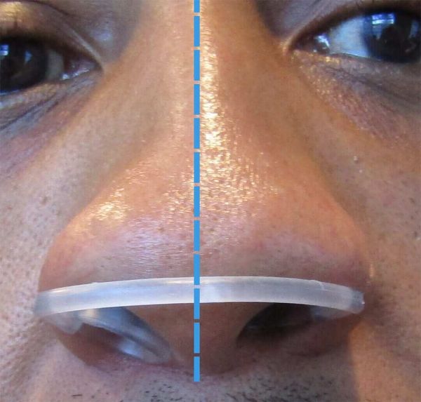 can you push a deviated septum