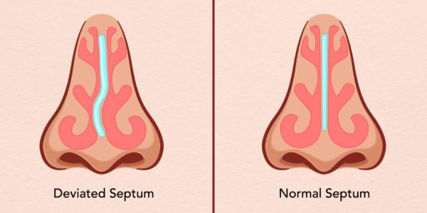 deviated septum device