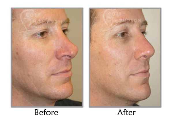 severly deviated septum