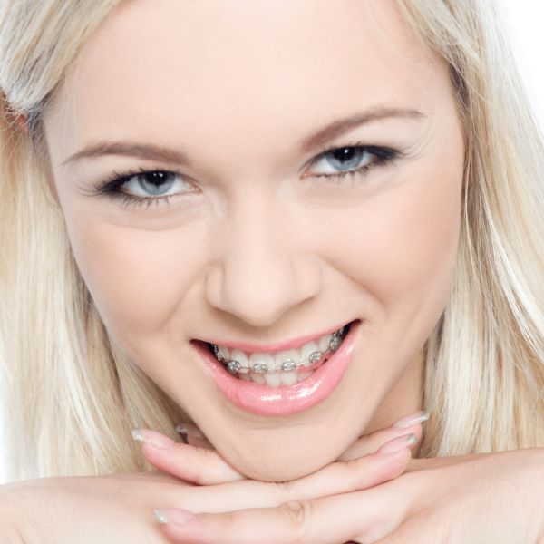 metal braces with silver bands