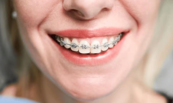 braces as adult